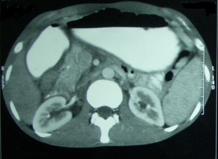 Figure 1: CT scan showing smooth distended stomach with partial outlet obstruction. No wall thickening or lesions are observed.